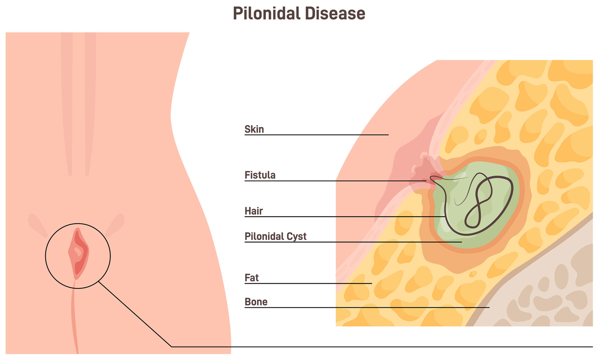 Pilonidal Sinus Treatment Image