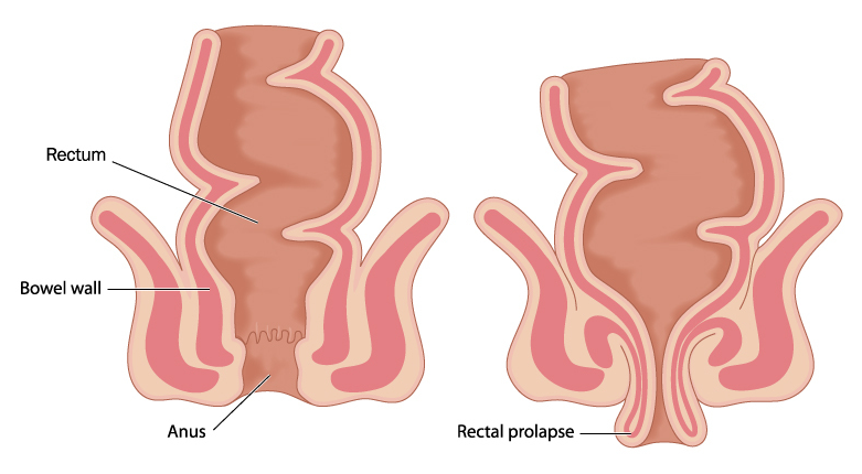 Rectal Prolapse Treatment Image