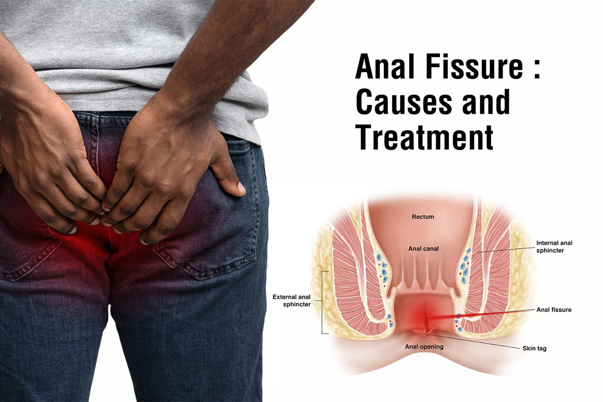 Fissure Treatment Image