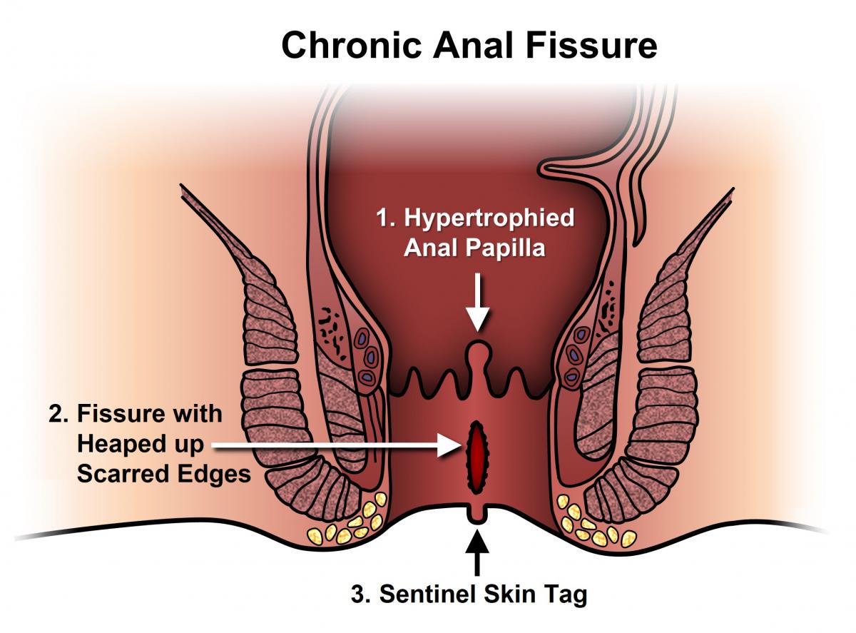 Fissure Treatment