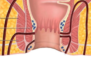 Fistula Treatment