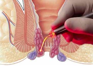 Piles Treatment