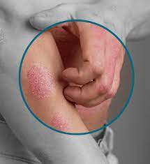 Psoriasis Treatment Procedure