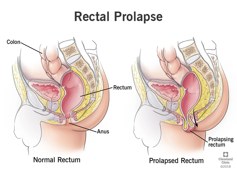 Rectal Prolapse Treatment