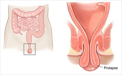 Rectal Polyp Treatment