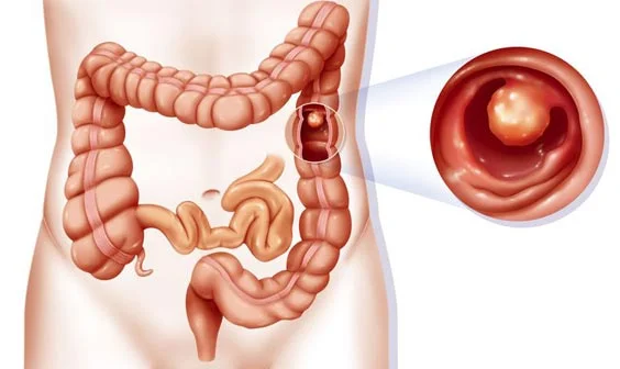 Rectal Polyp Treatment Image